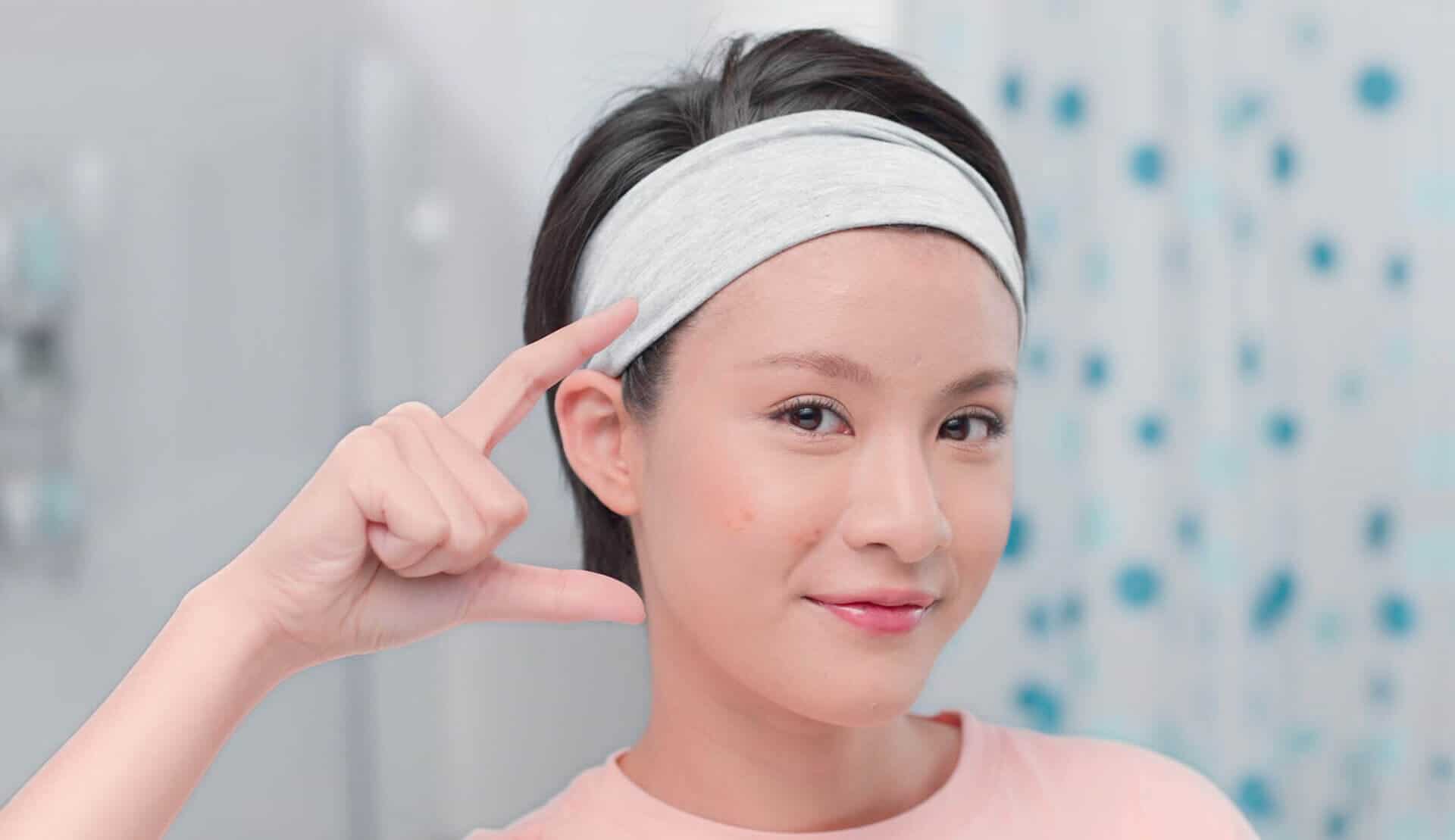 Sự thật về sẹo mụn ( VN 101 )